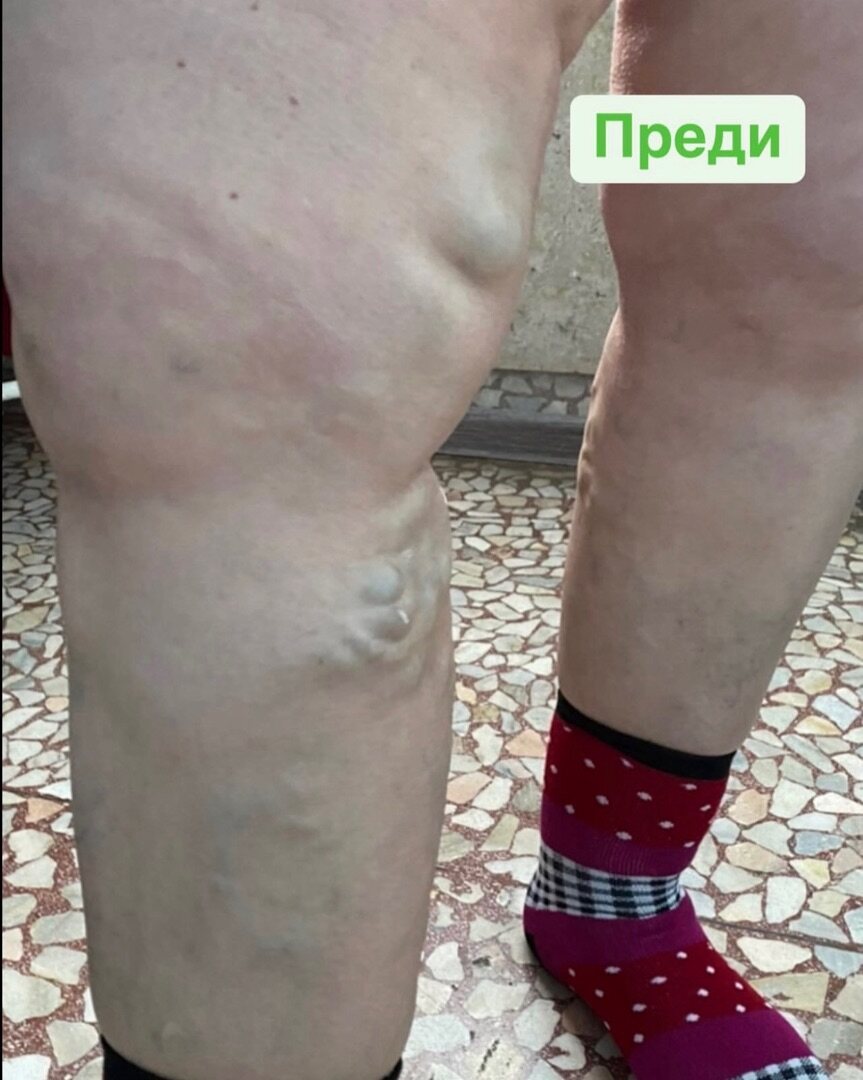 Клиничен случай — разширени вени